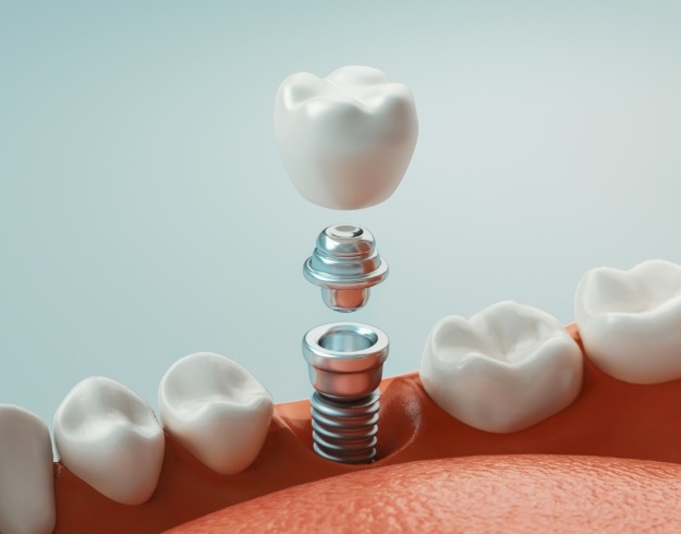 Dental Implants in Orlando, Florida: A Clear Guide to Timelines, Bone Support, and Long-Term Care